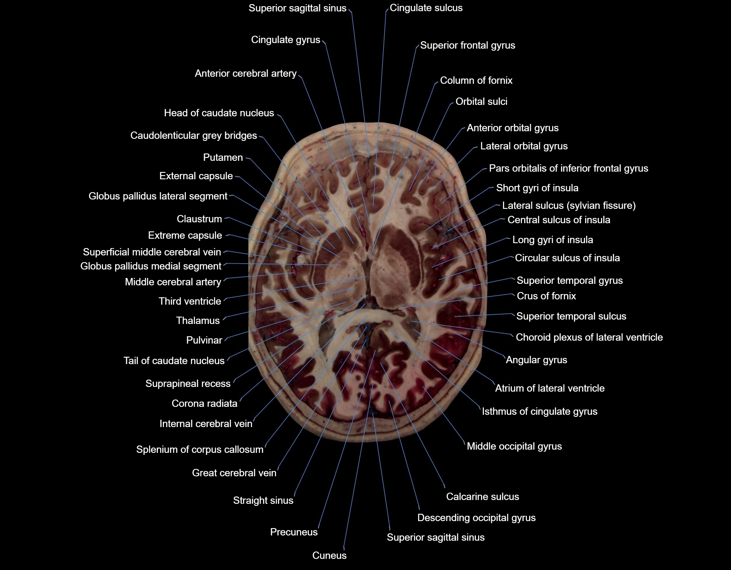 MRI Brain axial cross sectional radiology anatomy 3T image  -img-000042.webp